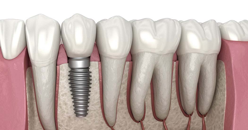 Full Mouth Rehabilitation Service in Paldi