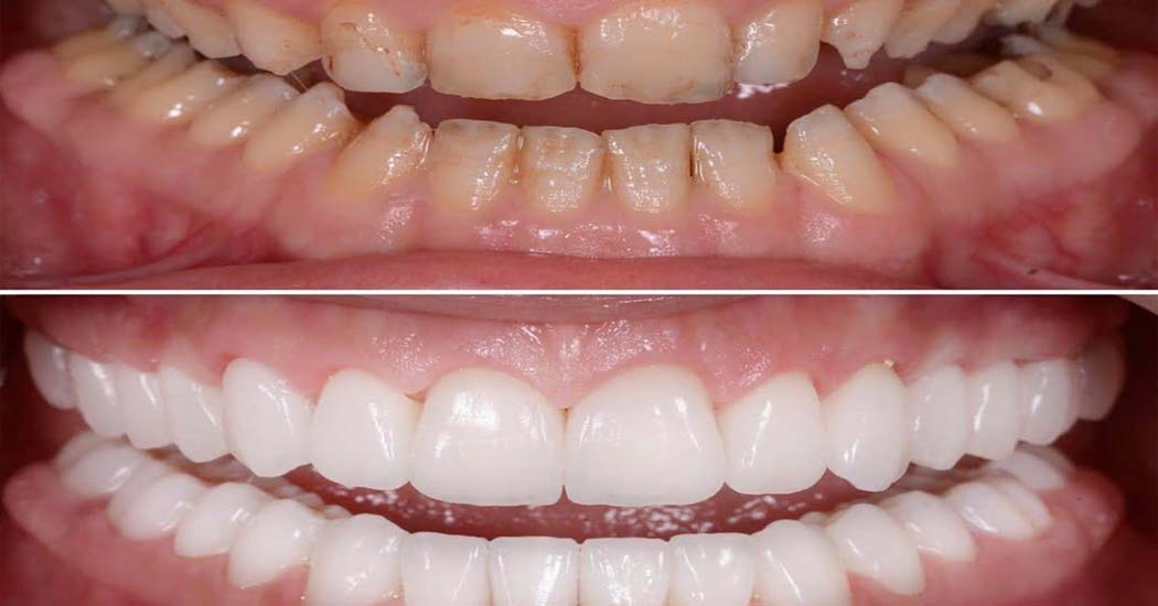 Full Mouth Rehabilitation Service in Paldi