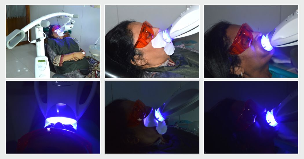 Crown & Bridges Service in Paldi